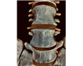 oorzaak fibromyalgie en chronische spierpijn
